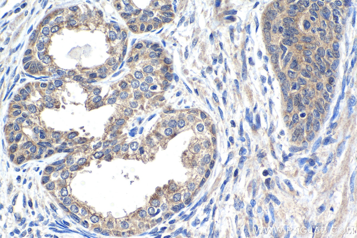 Immunohistochemical analysis of paraffin-embedded human prostate cancer tissue slide using KHC1422 (WASL IHC Kit).
