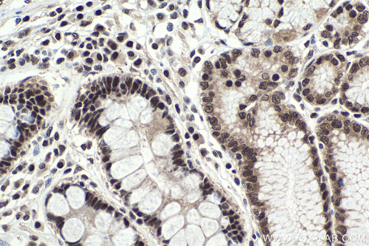 Immunohistochemical analysis of paraffin-embedded human stomach cancer tissue slide using KHC1916 (WDR33 IHC Kit).