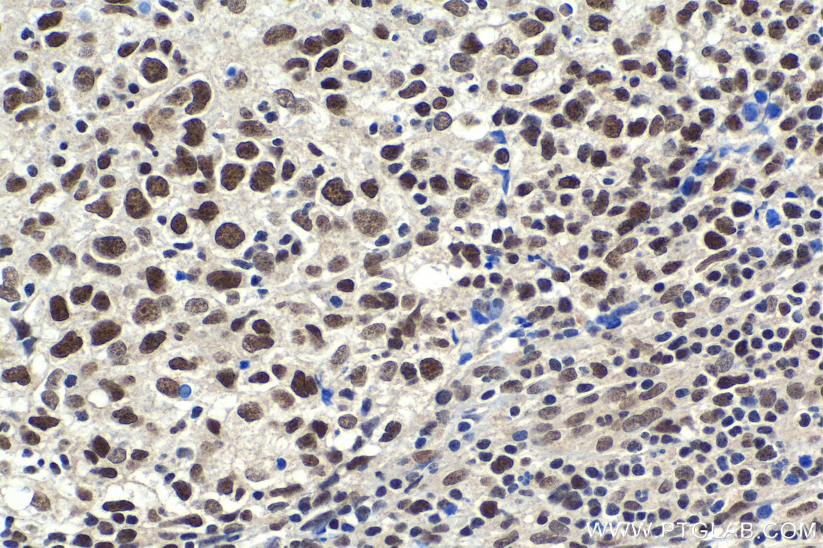 Immunohistochemical analysis of paraffin-embedded human lymphoma tissue slide using KHC1916 (WDR33 IHC Kit).