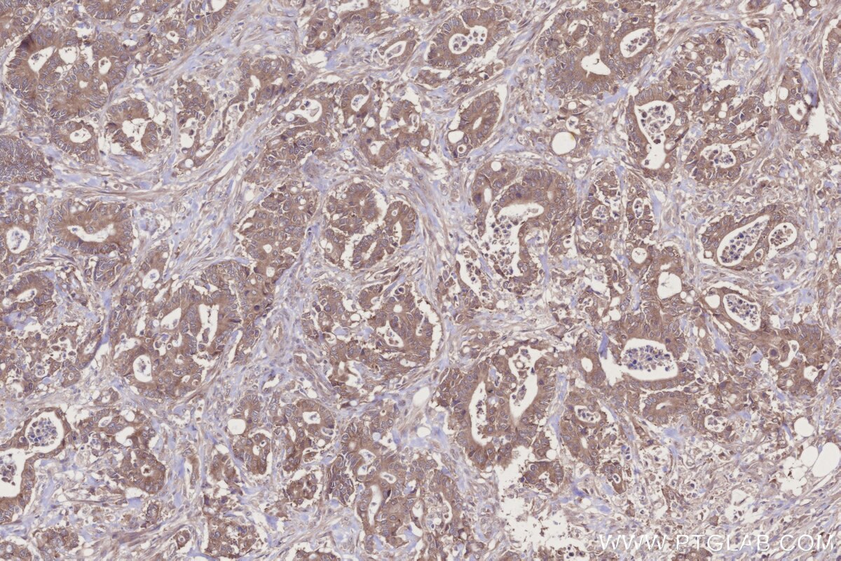 Immunohistochemical analysis of paraffin-embedded human rectal cancer tissue slide using KHC2728 (WIPF2 IHC Kit).