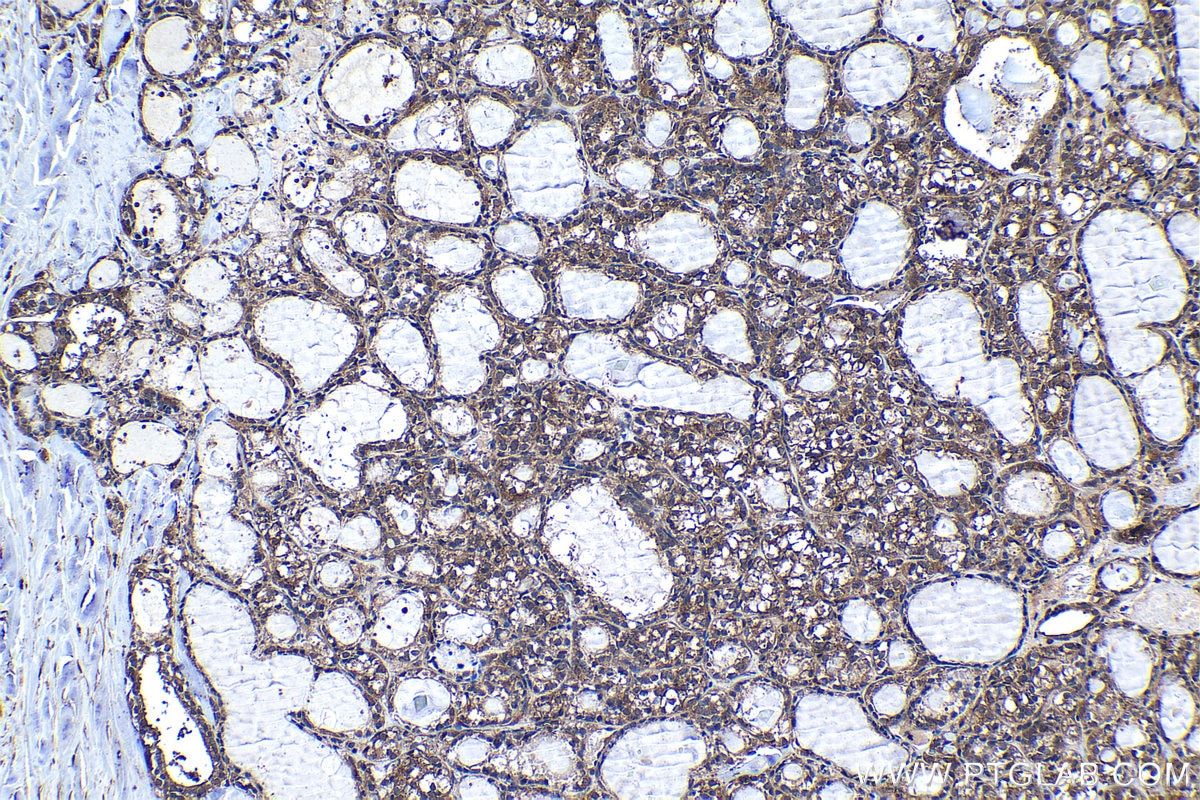 Immunohistochemical analysis of paraffin-embedded human thyroid cancer tissue slide using KHC1294 (WNK1 IHC Kit).