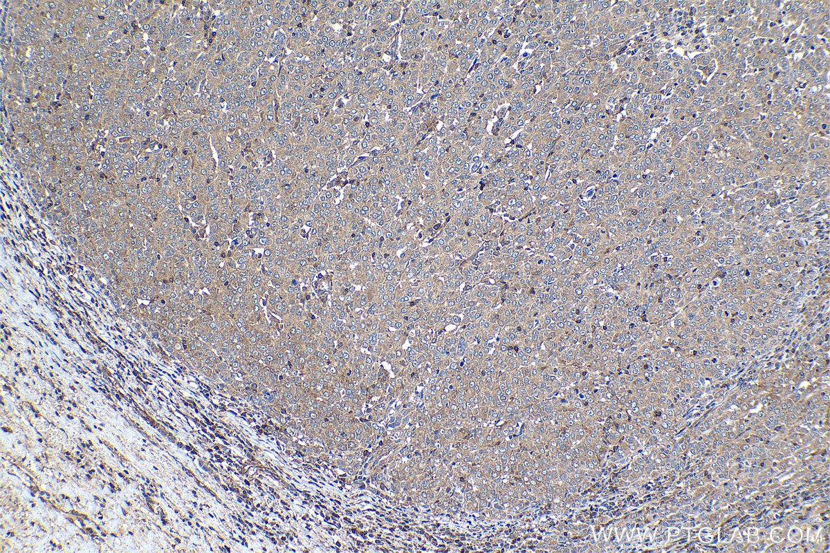 Immunohistochemical analysis of paraffin-embedded human ovary tumor tissue slide using KHC1294 (WNK1 IHC Kit).