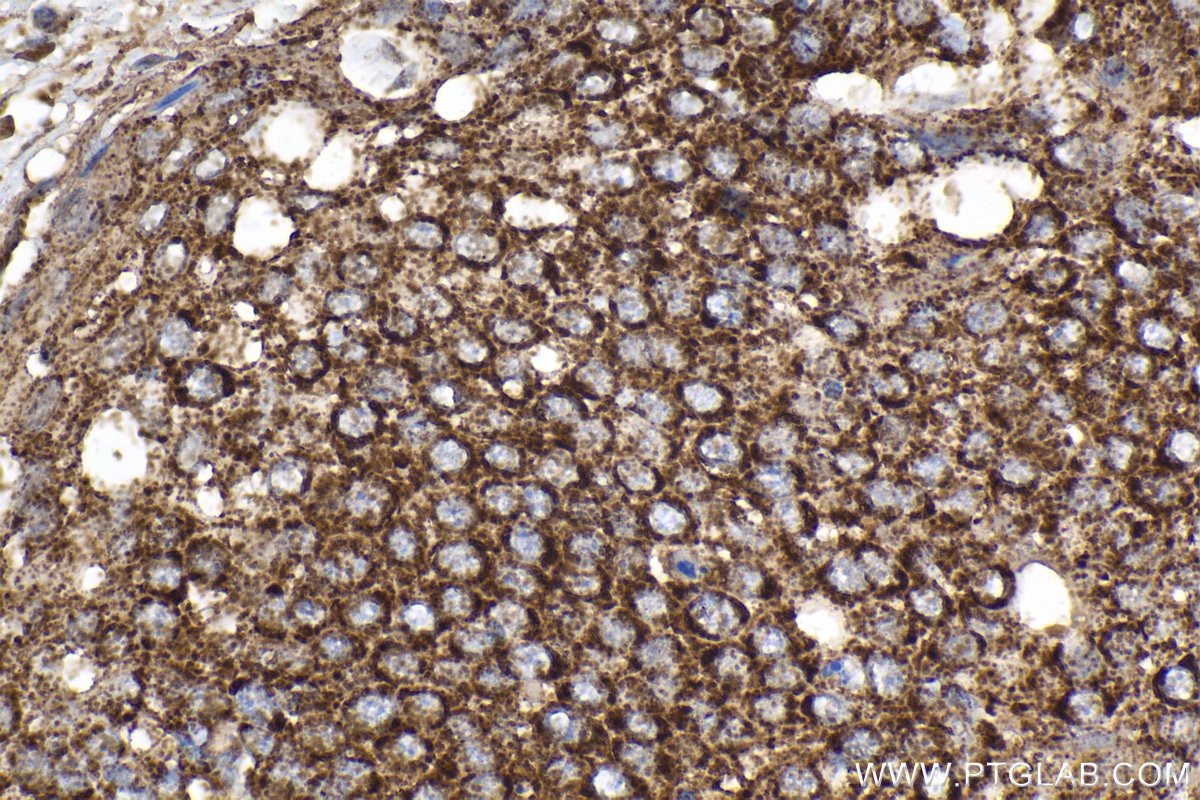 Immunohistochemical analysis of paraffin-embedded human cervical cancer tissue slide using KHC2051 (WNT10B IHC Kit).