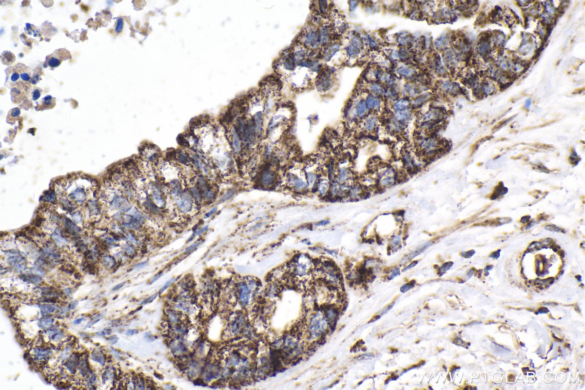 Immunohistochemical analysis of paraffin-embedded human pancreas cancer tissue slide using KHC2051 (WNT10B IHC Kit).