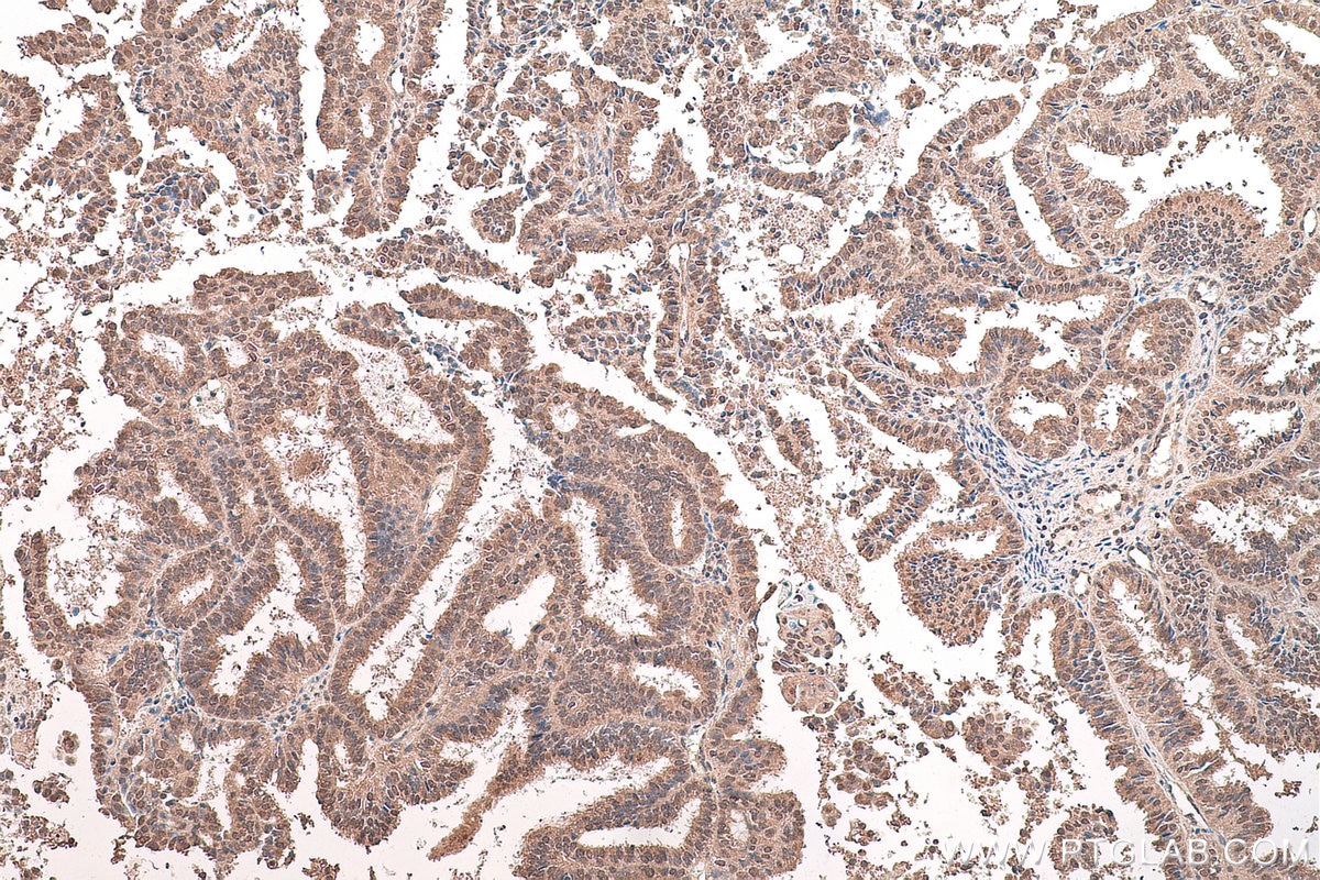 Immunohistochemical analysis of paraffin-embedded human ovary tumor tissue slide using KHC0651 (WWOX IHC Kit).