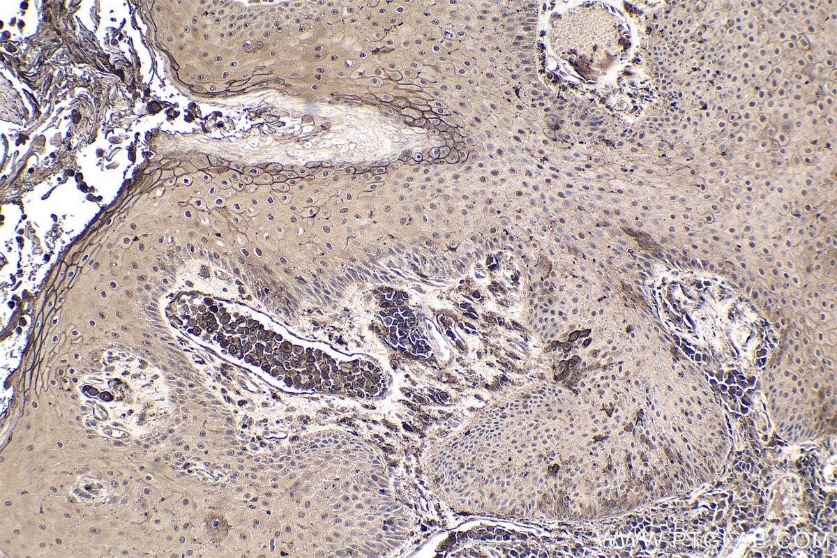 Immunohistochemical analysis of paraffin-embedded human malignant melanoma tissue slide using KHC1920 (WWP1 IHC Kit).