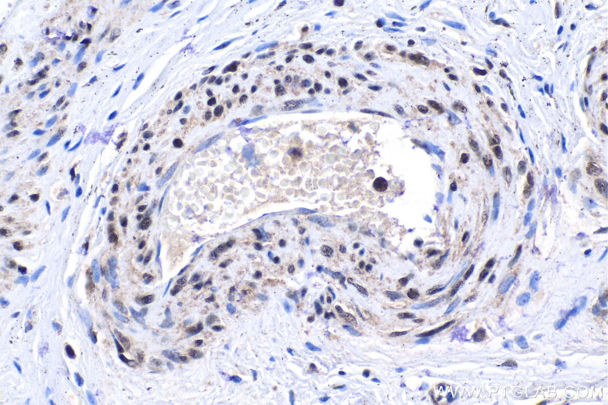 Immunohistochemical analysis of paraffin-embedded human cervical cancer tissue slide using KHC1947 (XAB2 IHC Kit).