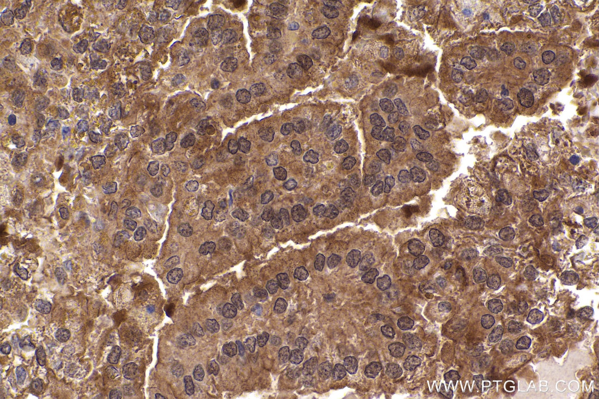 Immunohistochemical analysis of paraffin-embedded human renal cell carcinoma tissue slide using KHC2377 (XIAP IHC Kit).
