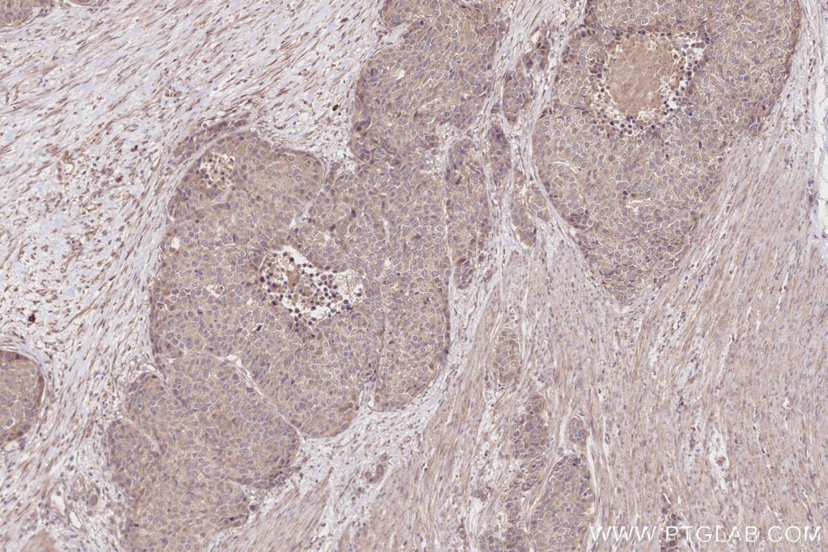 Immunohistochemical analysis of paraffin-embedded human stomach cancer tissue slide using KHC2822 (XPO6 IHC Kit).