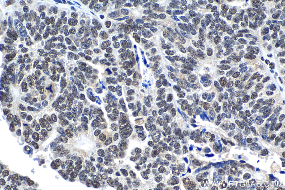 Immunohistochemical analysis of paraffin-embedded human ovary tumor tissue slide using KHC1184 (XRCC4 IHC Kit).