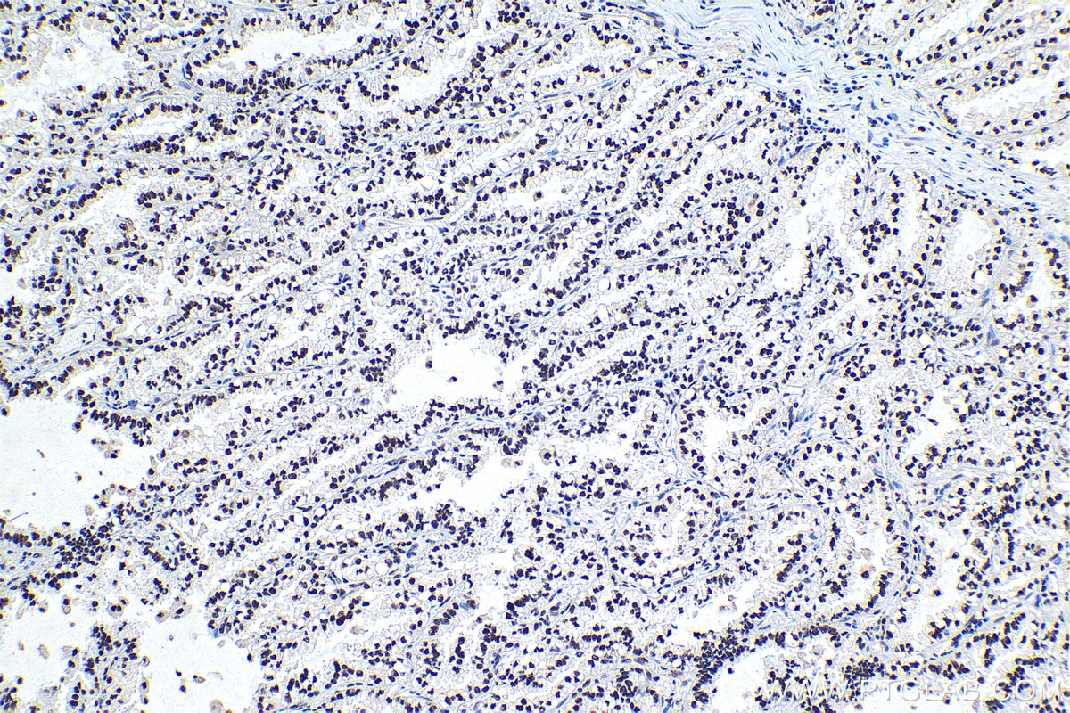 Immunohistochemical analysis of paraffin-embedded human lung cancer tissue slide using KHC1184 (XRCC4 IHC Kit).