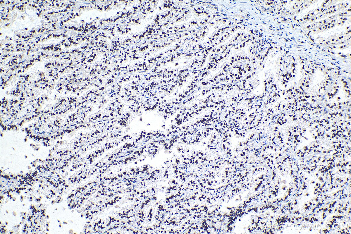 Immunohistochemical analysis of paraffin-embedded human lung cancer tissue slide using KHC1184 (XRCC4 IHC Kit).