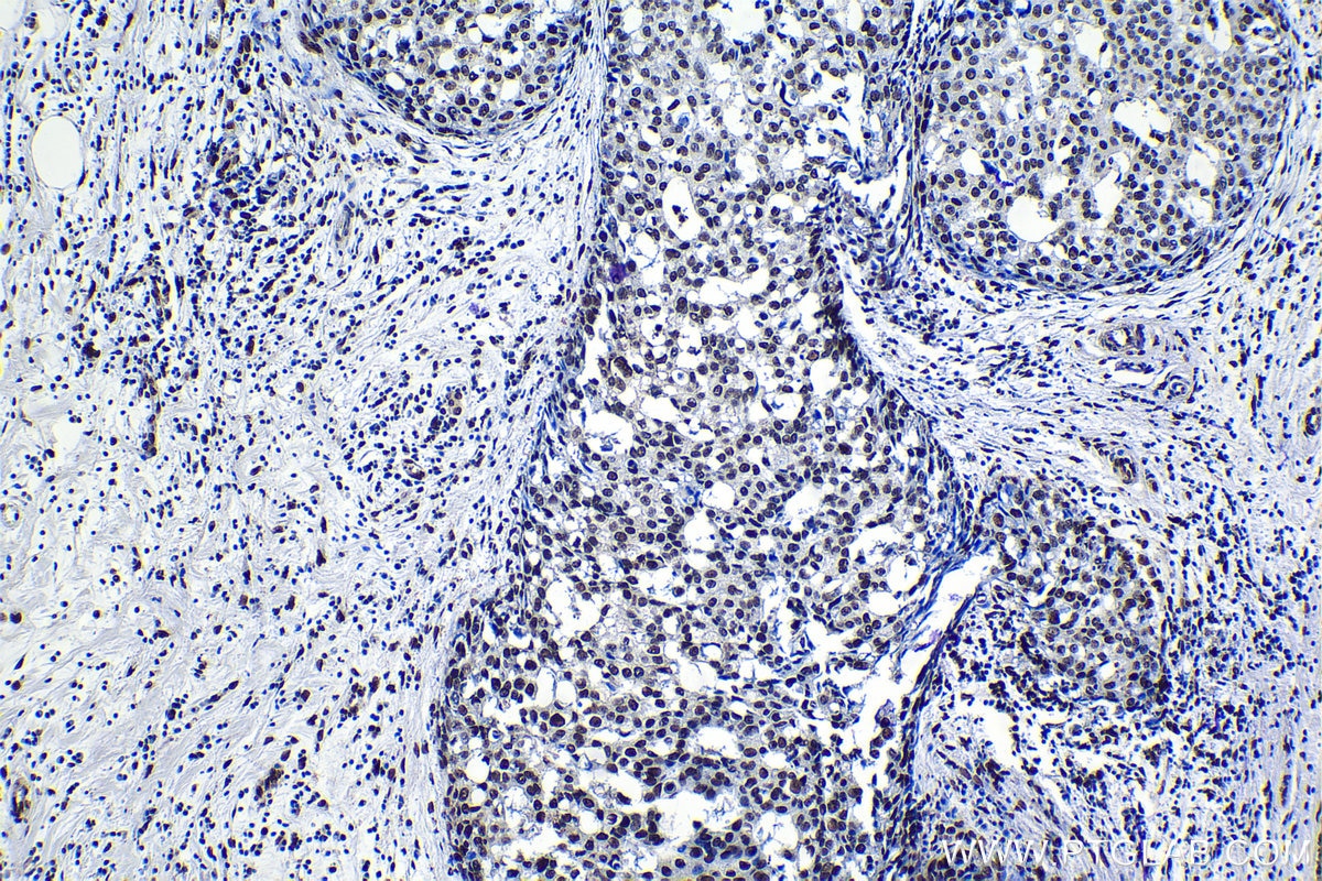 Immunohistochemical analysis of paraffin-embedded human breast cancer tissue slide using KHC1184 (XRCC4 IHC Kit).