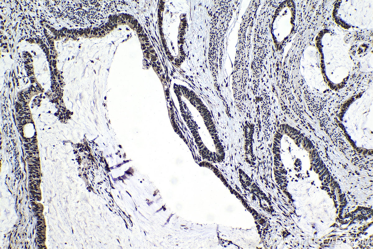 Immunohistochemical analysis of paraffin-embedded human urothelial carcinoma tissue slide using KHC1528 (XRCC5 IHC Kit).