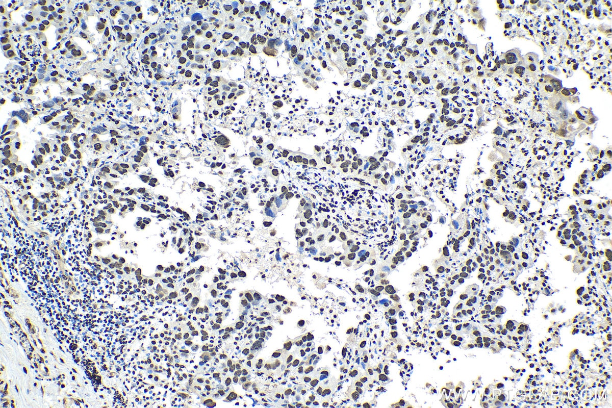 Immunohistochemical analysis of paraffin-embedded human lung cancer tissue slide using KHC1528 (XRCC5 IHC Kit).