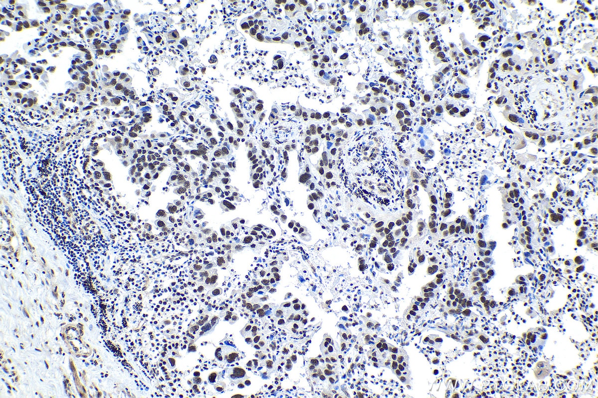 Immunohistochemical analysis of paraffin-embedded human lung cancer tissue slide using KHC1527 (XRCC6 IHC Kit).