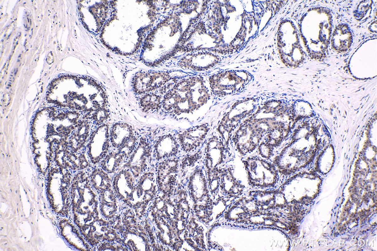 Immunohistochemical analysis of paraffin-embedded human breast cancer tissue slide using KHC1381 (XRN2 IHC Kit).