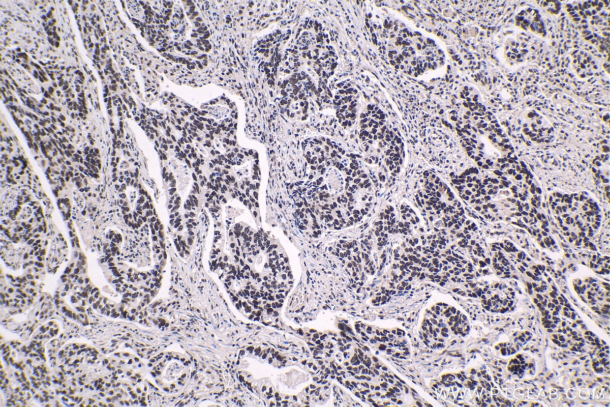 Immunohistochemical analysis of paraffin-embedded human stomach cancer tissue slide using KHC1381 (XRN2 IHC Kit).