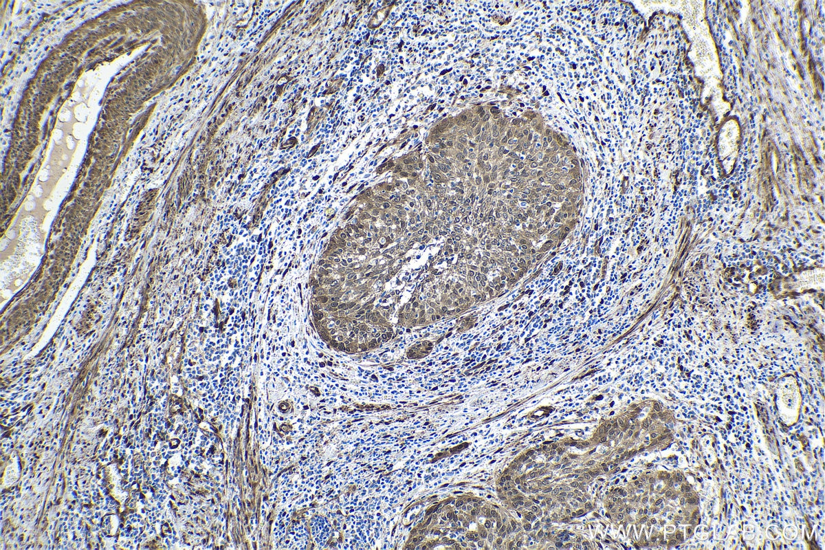 Immunohistochemical analysis of paraffin-embedded human cervical cancer tissue slide using KHC1608 (YAP1 IHC Kit).