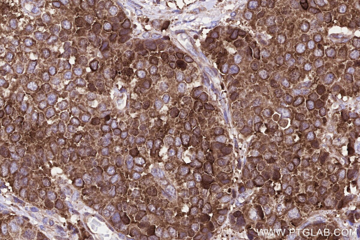 Immunohistochemical analysis of paraffin-embedded human stomach cancer tissue slide using KHC3228 (YARS IHC Kit). Immunohistochemical analysis of paraffin-embedded human stomach cancer tissue slide using KHC3228 (YARS IHC Kit).