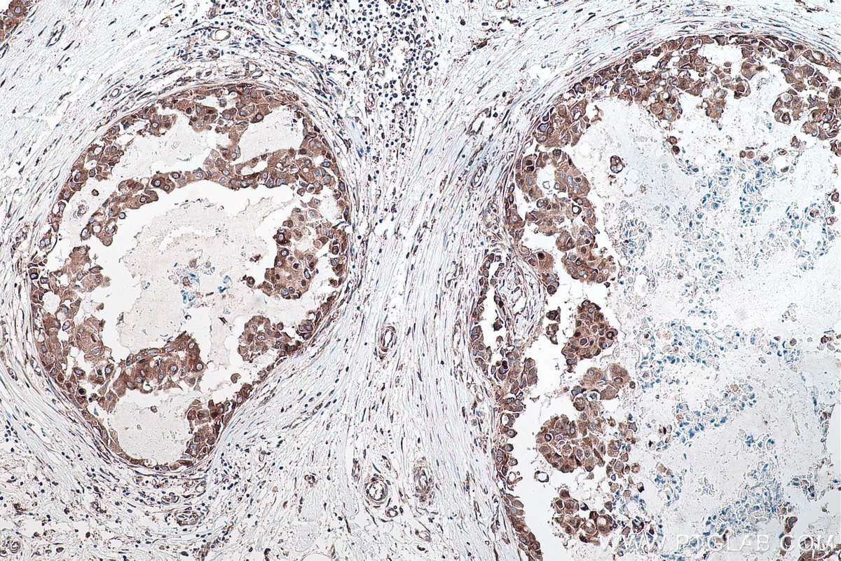 Immunohistochemical analysis of paraffin-embedded human breast cancer tissue slide using KHC0176 (YBX1 IHC Kit).