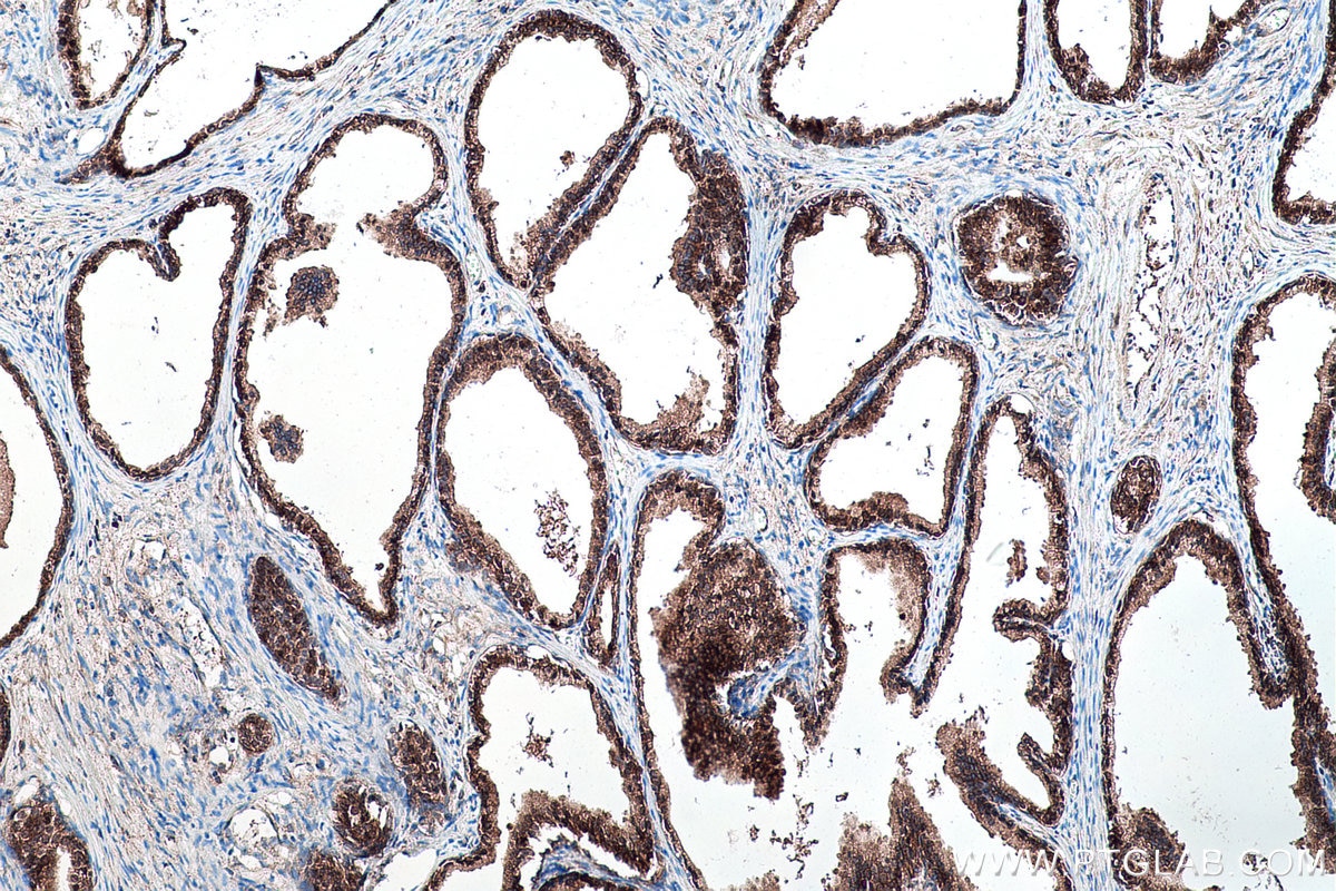 Immunohistochemical analysis of paraffin-embedded human prostate cancer tissue slide using KHC0176 (YBX1 IHC Kit).