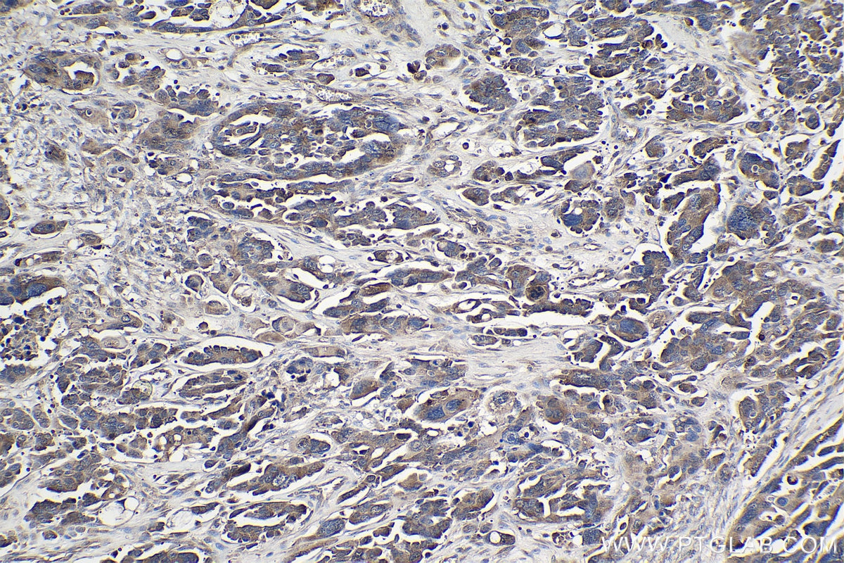 Immunohistochemical analysis of paraffin-embedded human colon cancer tissue slide using KHC1012 (YPEL5 IHC Kit).