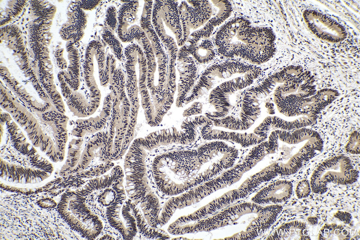 Immunohistochemical analysis of paraffin-embedded human colon cancer tissue slide using KHC0155 (YTHDC1 IHC Kit).