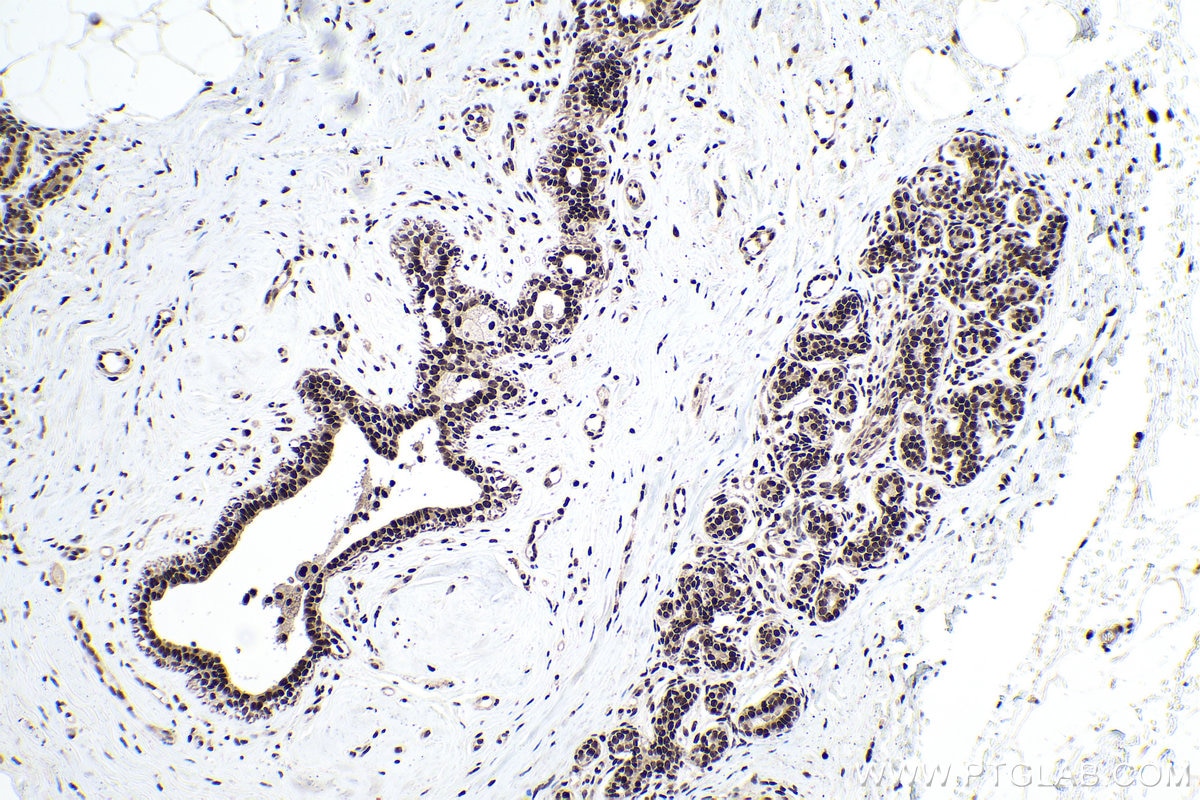 Immunohistochemical analysis of paraffin-embedded human breast cancer tissue slide using KHC0155 (YTHDC1 IHC Kit).