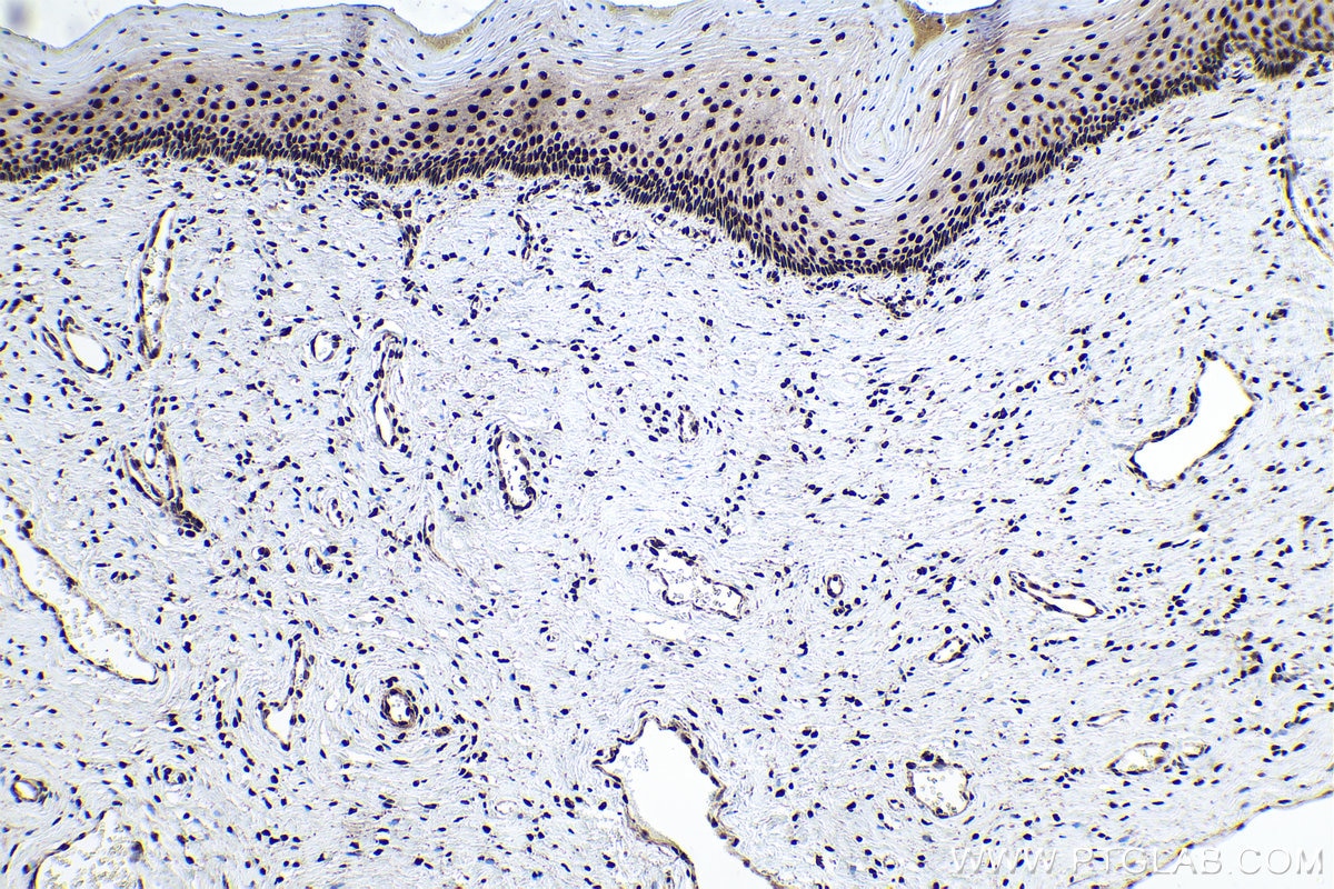 Immunohistochemical analysis of paraffin-embedded human cervical cancer tissue slide using KHC0155 (YTHDC1 IHC Kit).