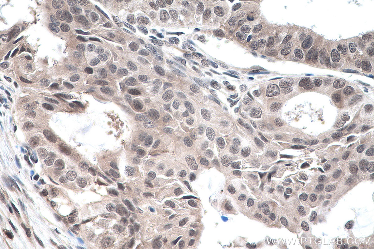 Immunohistochemical analysis of paraffin-embedded human ovary tumor tissue slide using KHC0158 (YTHDF2 IHC Kit).