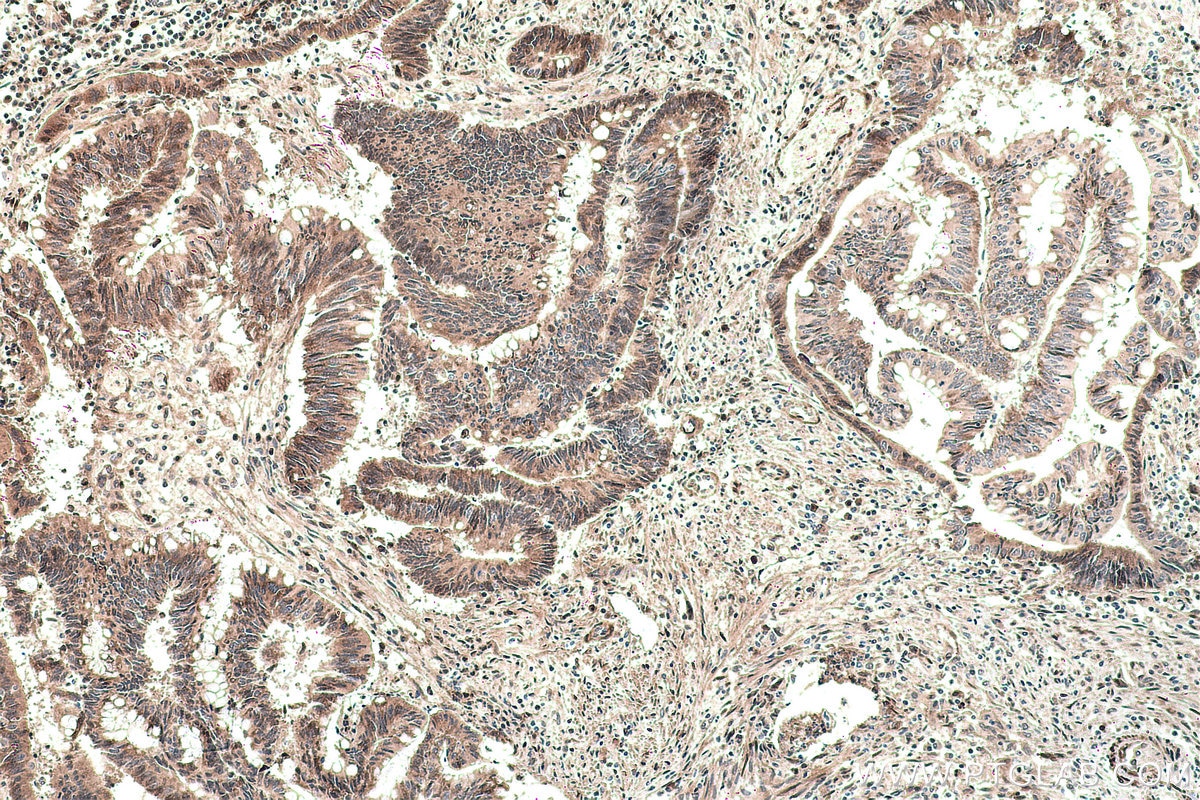 Immunohistochemical analysis of paraffin-embedded human colon cancer tissue slide using KHC0158 (YTHDF2 IHC Kit).