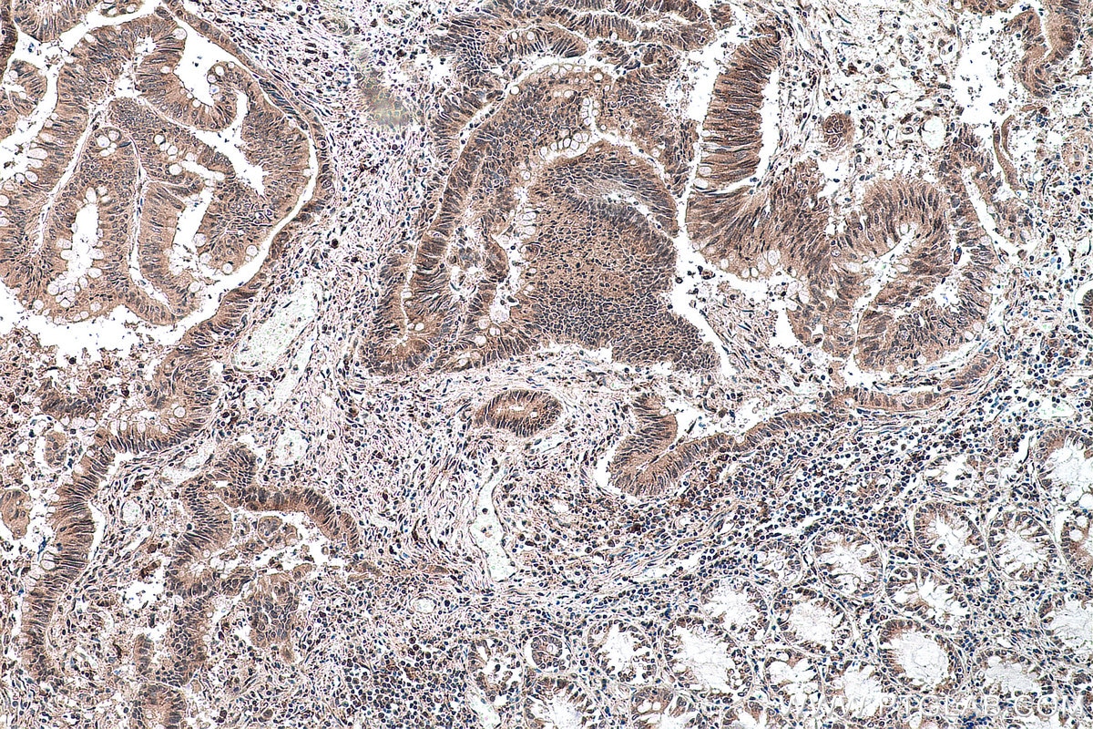 Immunohistochemical analysis of paraffin-embedded human colon cancer tissue slide using KHC0159 (YTHDF3-specific IHC Kit).