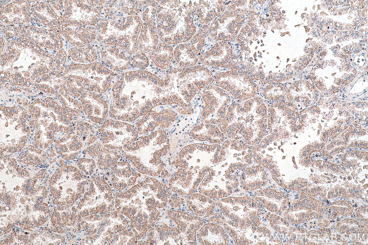 Immunohistochemical analysis of paraffin-embedded human lung cancer tissue slide using KHC0701 (YWHAB IHC Kit).