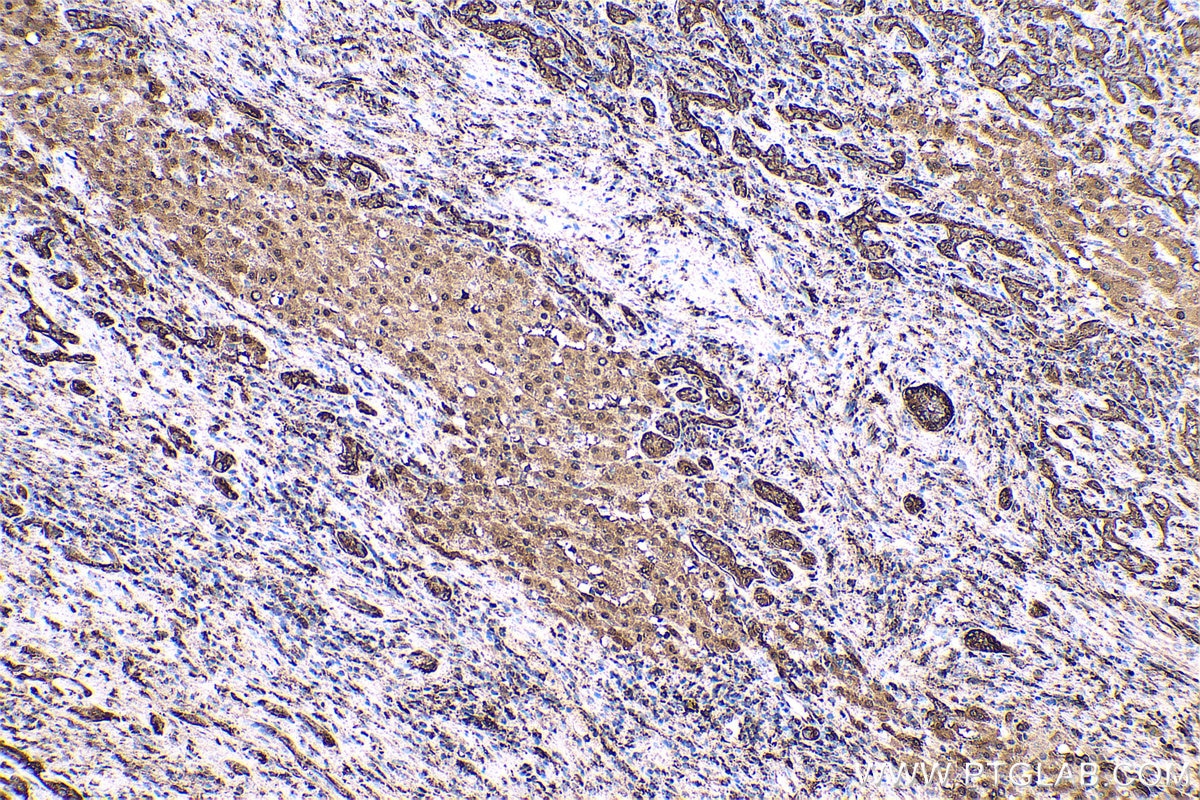 Immunohistochemical analysis of paraffin-embedded human liver cancer tissue slide using KHC0558 (YWHAE IHC Kit).