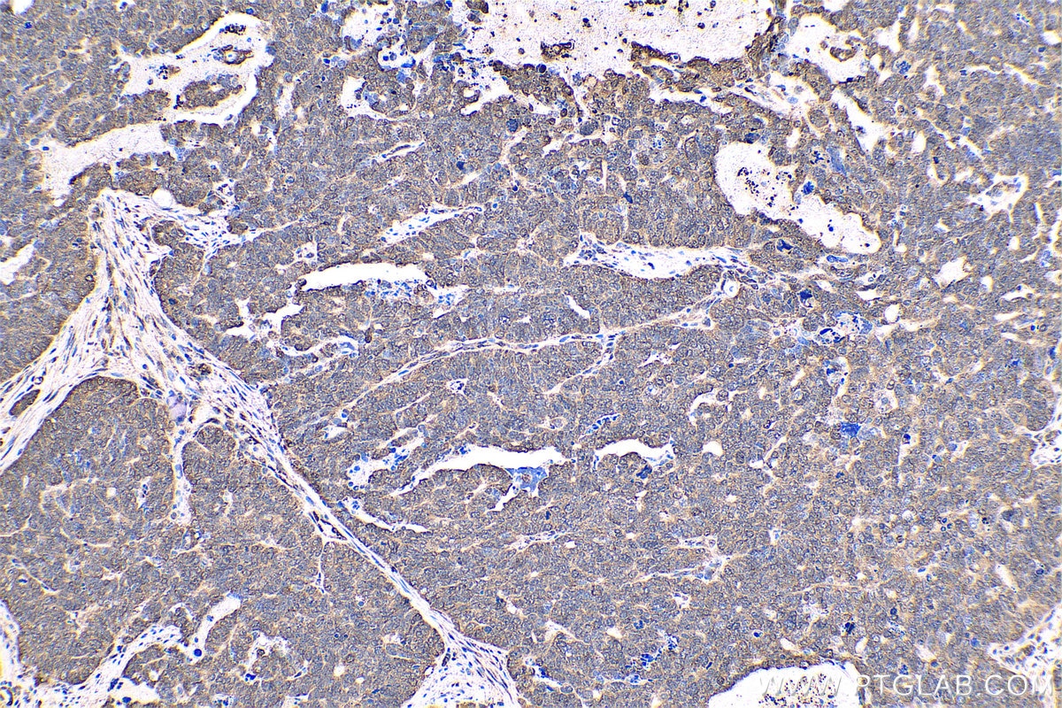Immunohistochemical analysis of paraffin-embedded human ovary tumor tissue slide using KHC0558 (YWHAE IHC Kit).