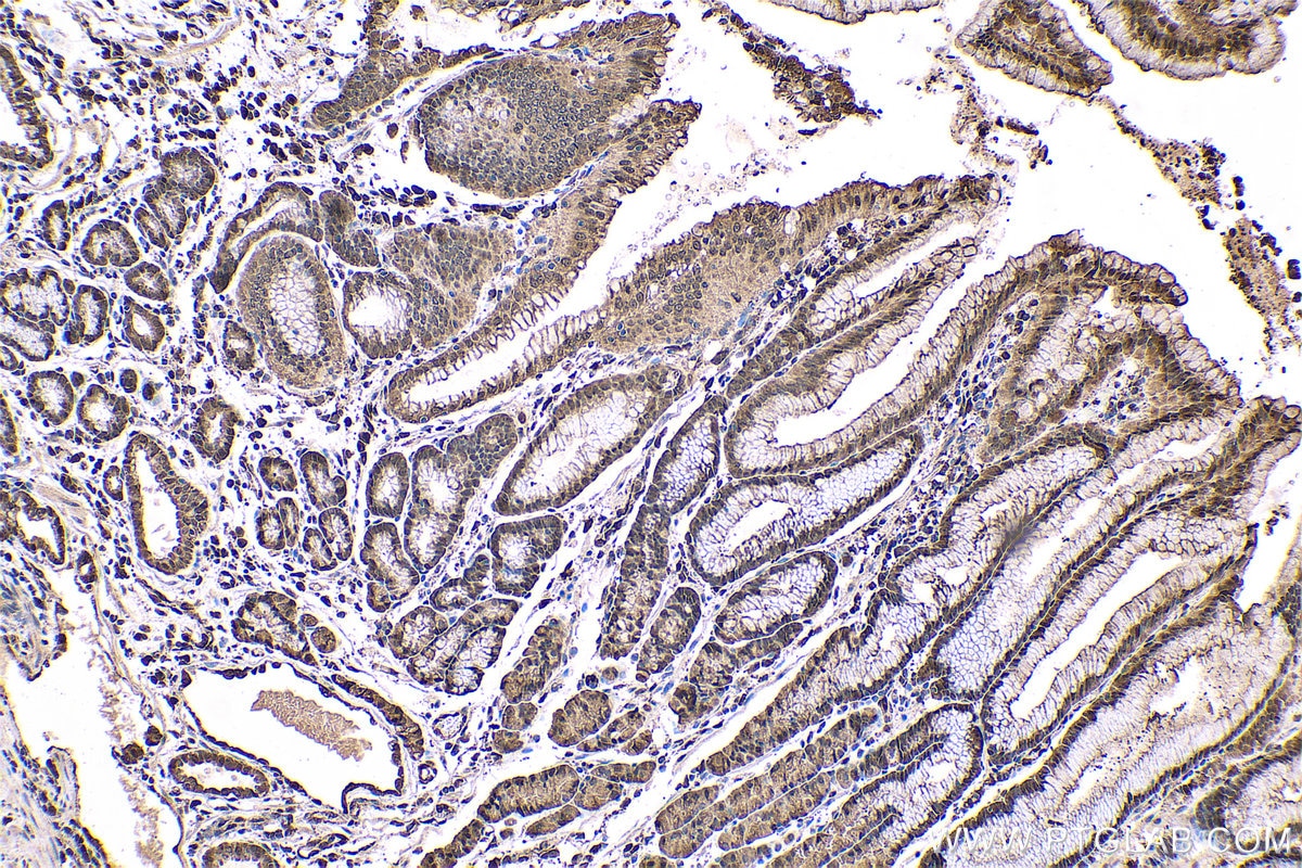 Immunohistochemical analysis of paraffin-embedded human stomach cancer tissue slide using KHC0558 (YWHAE IHC Kit).