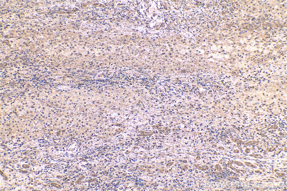 Immunohistochemical analysis of paraffin-embedded human liver cancer tissue slide using KHC0559 (YWHAZ IHC Kit).