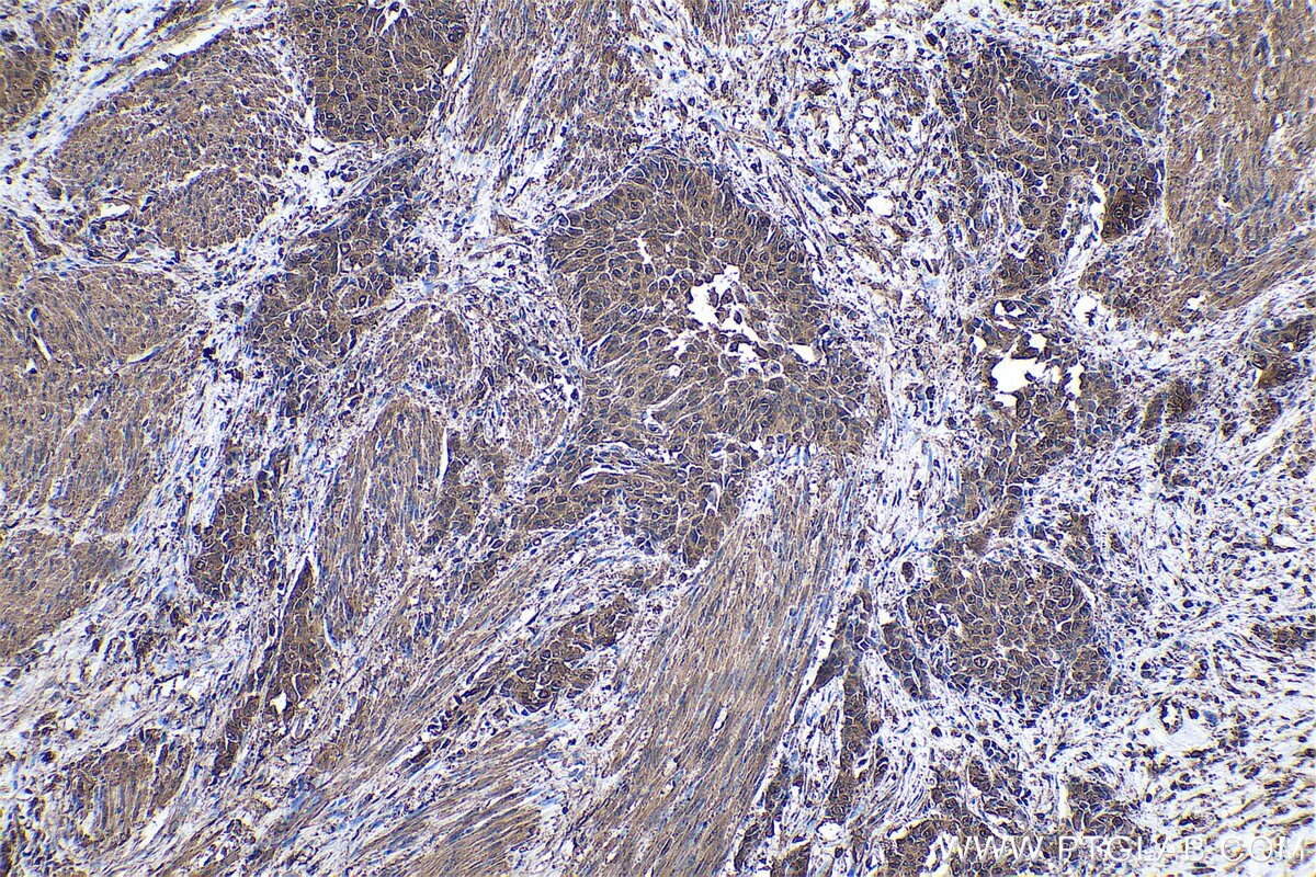 Immunohistochemical analysis of paraffin-embedded human urothelial carcinoma tissue slide using KHC0559 (YWHAZ IHC Kit).