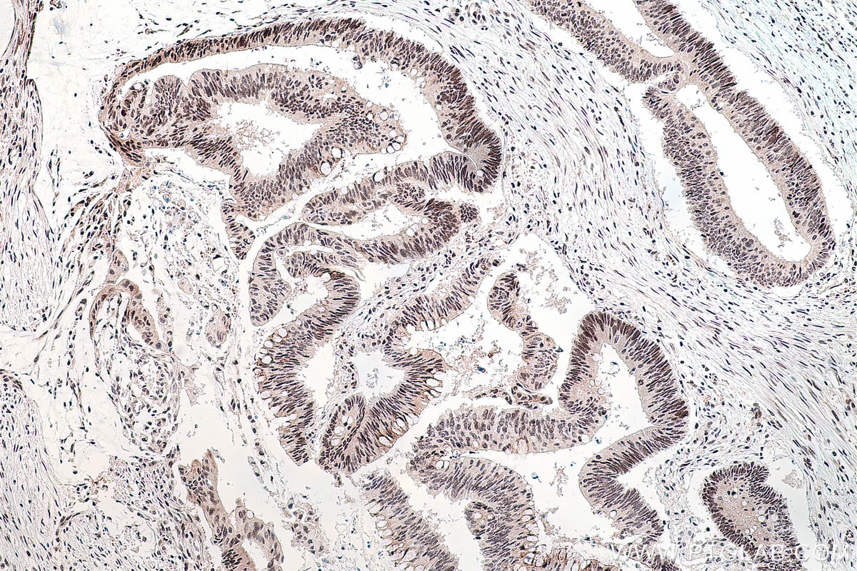 Immunohistochemical analysis of paraffin-embedded human colon cancer tissue slide using KHC0132 (YY1 IHC Kit).