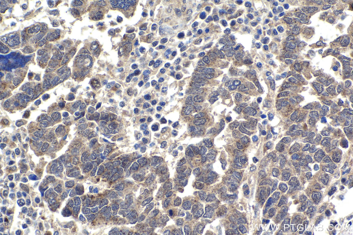 Immunohistochemical analysis of paraffin-embedded human ovary tumor tissue slide using KHC1805 (ZBTB33 IHC Kit).