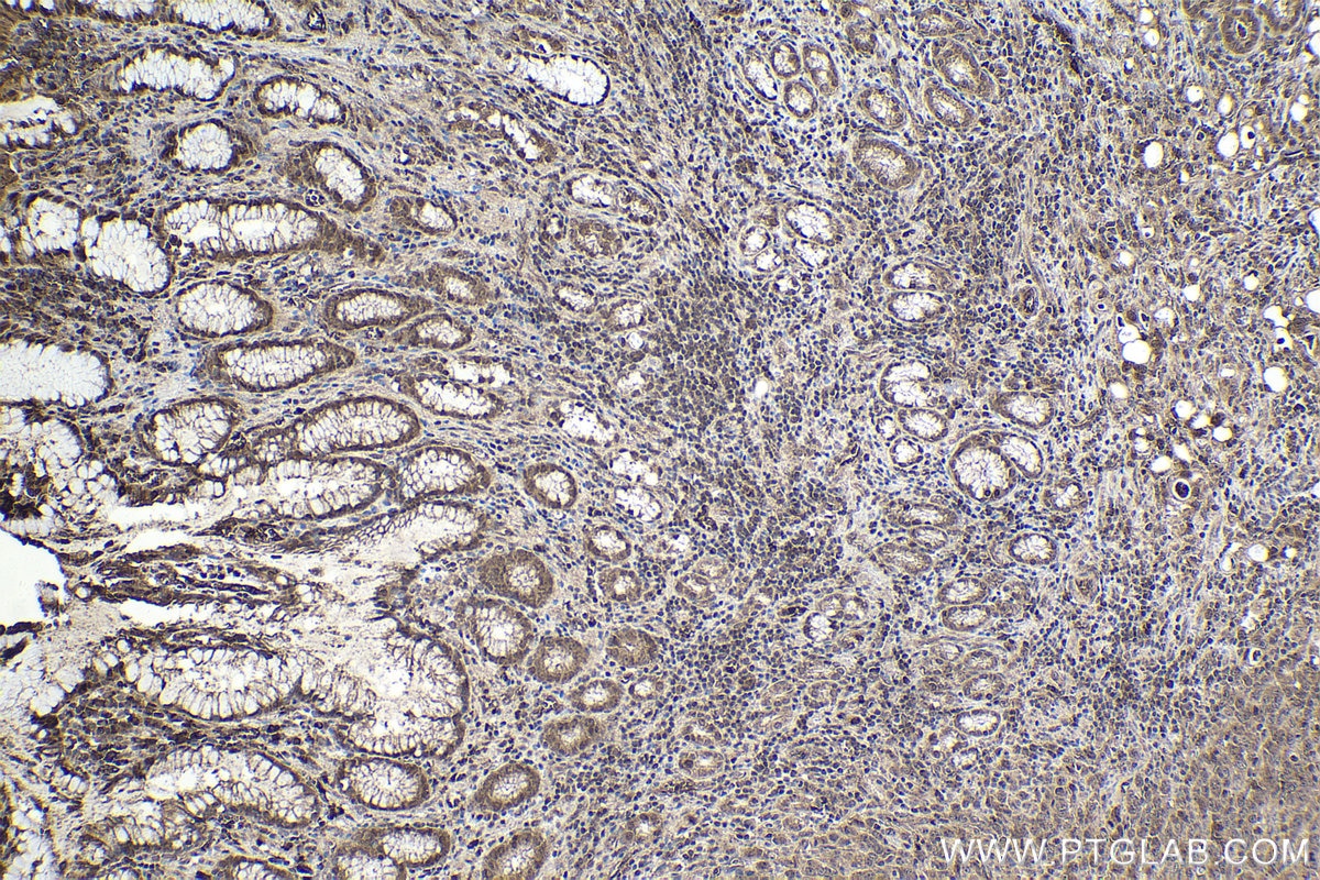 Immunohistochemical analysis of paraffin-embedded human stomach cancer tissue slide using KHC1805 (ZBTB33 IHC Kit).