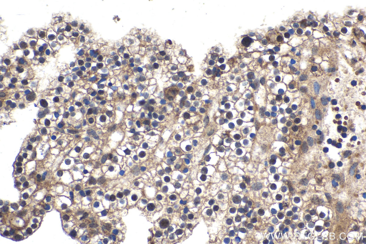Immunohistochemical analysis of paraffin-embedded human renal cell carcinoma tissue slide using KHC1794 (ZBTB49 IHC Kit).