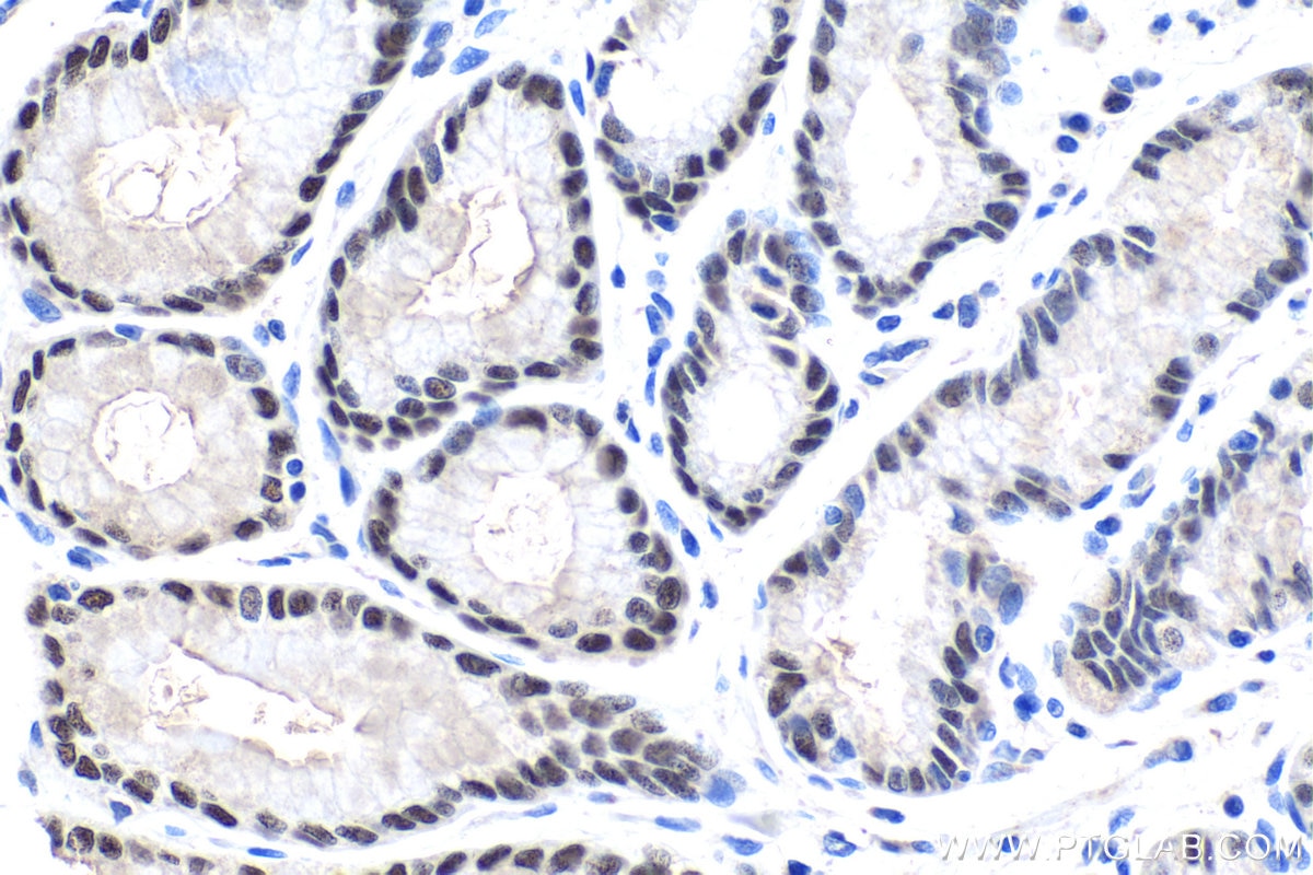 Immunohistochemical analysis of paraffin-embedded human stomach cancer tissue slide using KHC1435 (ZBTB7B IHC Kit).