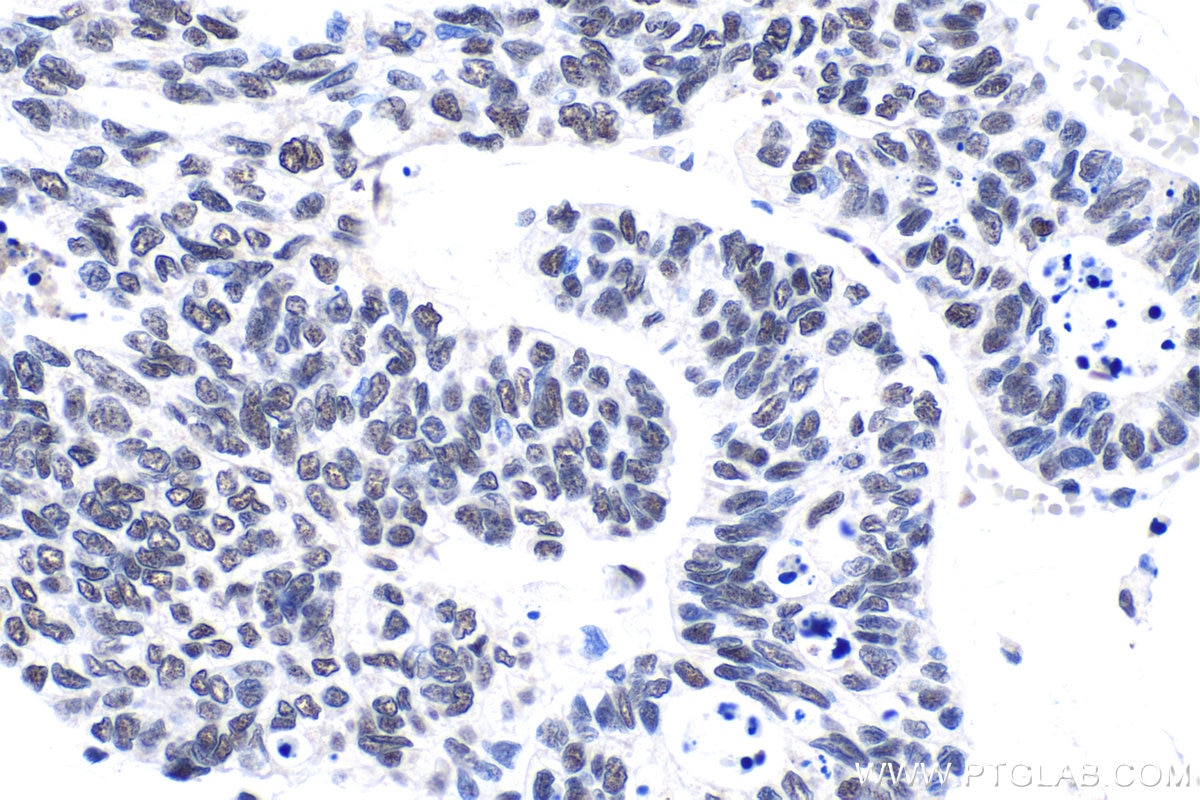 Immunohistochemical analysis of paraffin-embedded human urothelial carcinoma tissue slide using KHC1435 (ZBTB7B IHC Kit).