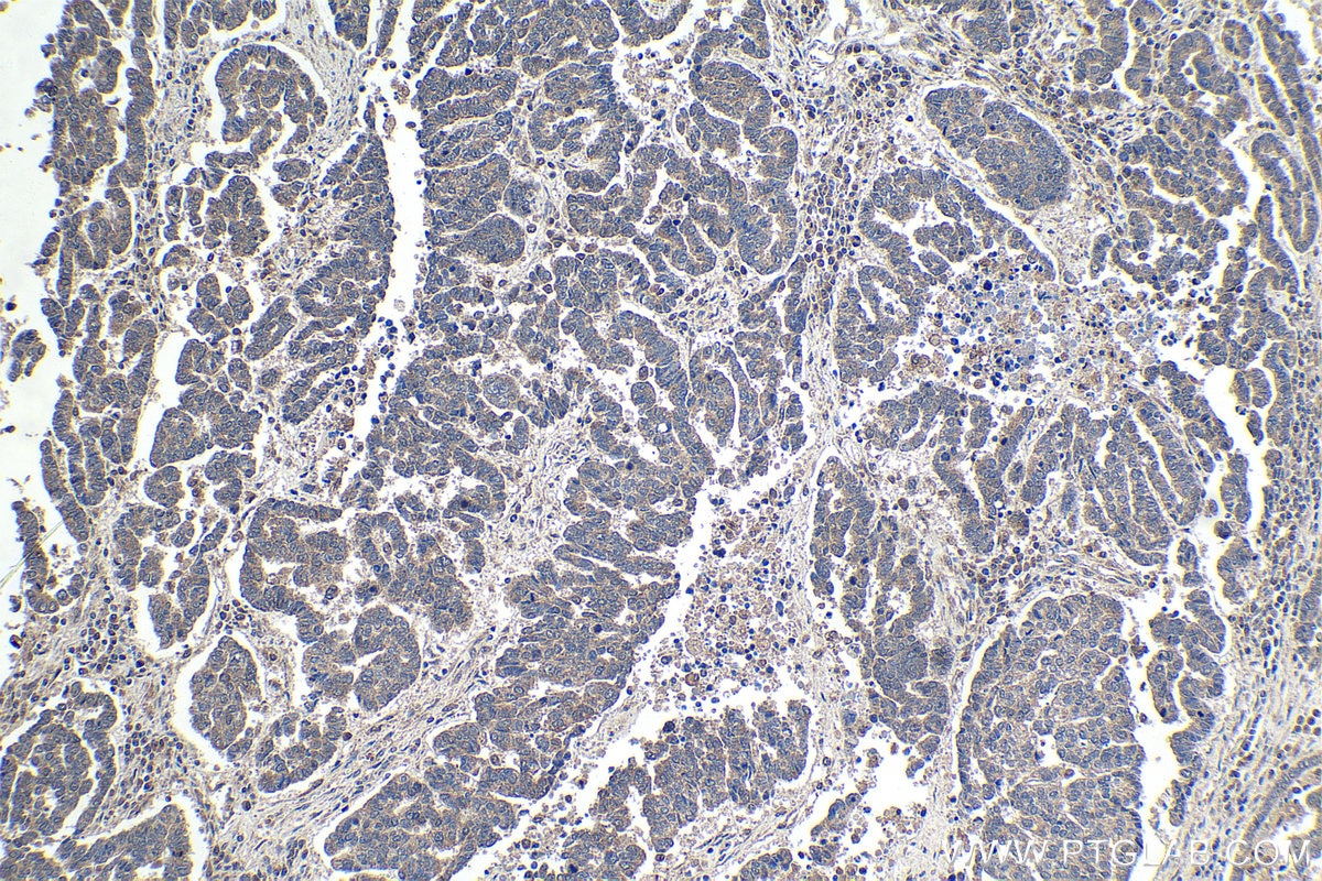 Immunohistochemical analysis of paraffin-embedded human ovary tumor tissue slide using KHC1774 (ZC3H12A IHC Kit).