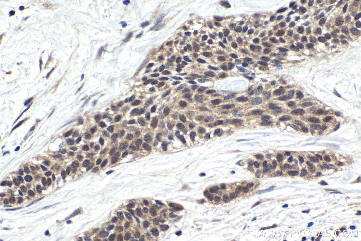 Immunohistochemical analysis of paraffin-embedded human urothelial carcinoma tissue slide using KHC1774 (ZC3H12A IHC Kit).