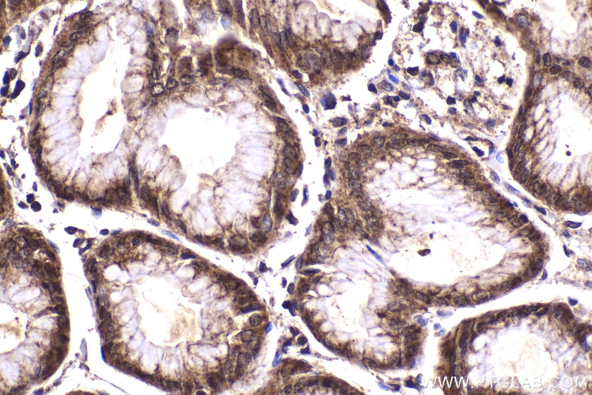 Immunohistochemical analysis of paraffin-embedded human stomach cancer tissue slide using KHC2038 (ZC3H12D IHC Kit).