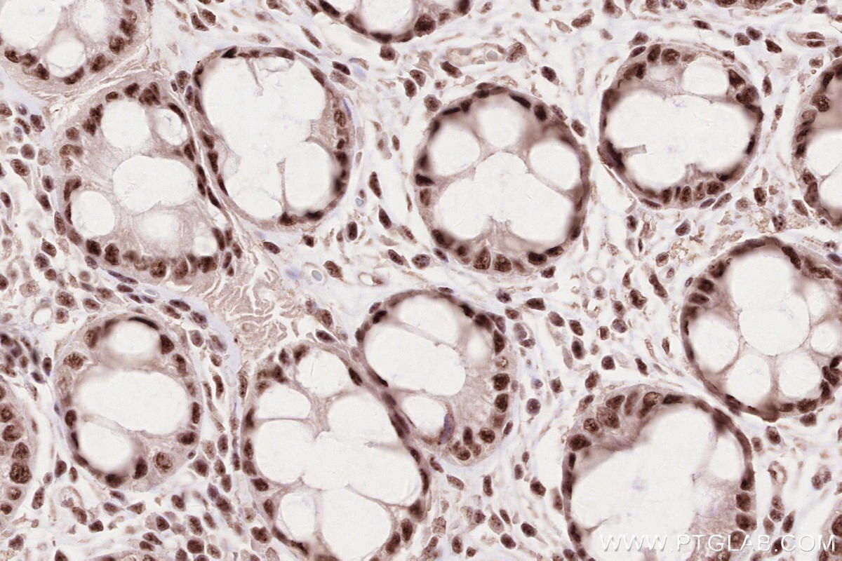 Immunohistochemical analysis of paraffin-embedded human rectal cancer tissue slide using KHC2593 (ZC3H14 IHC Kit).