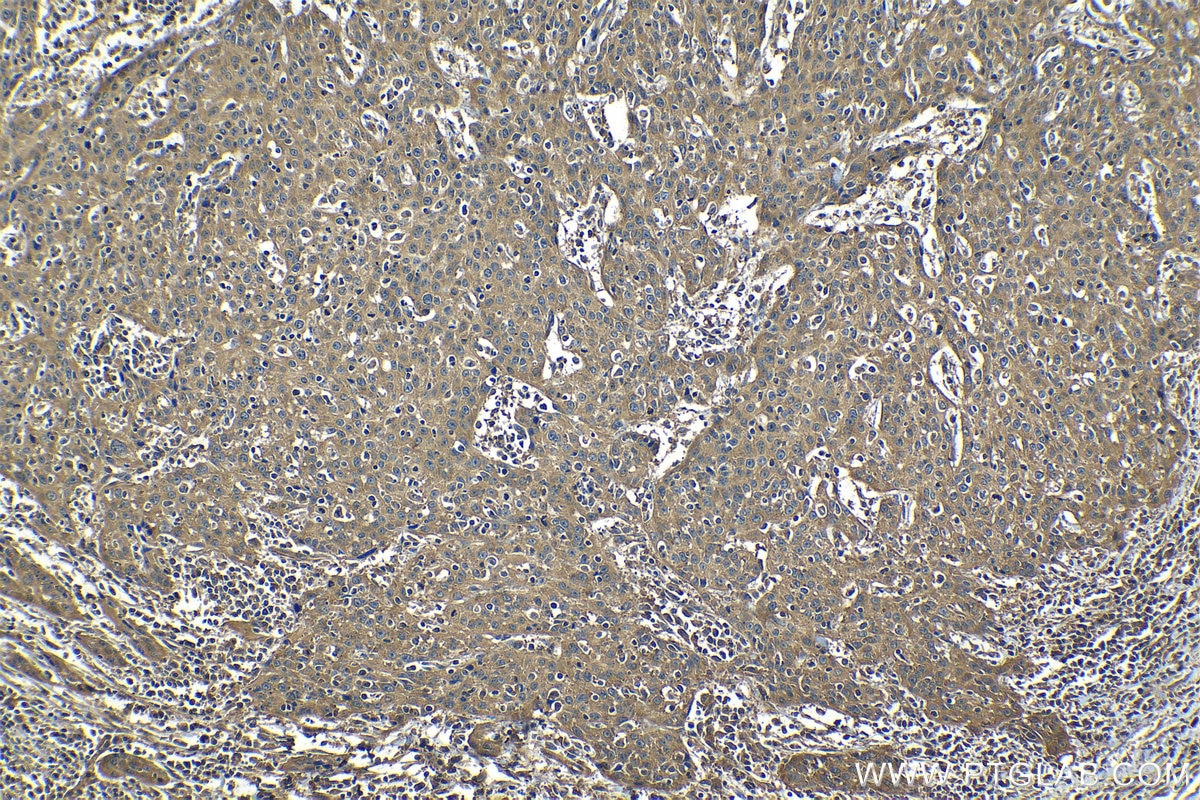 Immunohistochemical analysis of paraffin-embedded human cervical cancer tissue slide using KHC1232 (ZC3H15 IHC Kit).